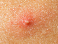 Acné en la piel de la cara