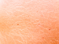 El aceite de aguacate combate las estrías