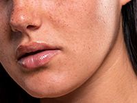 El ácido tranexámico previene manchas