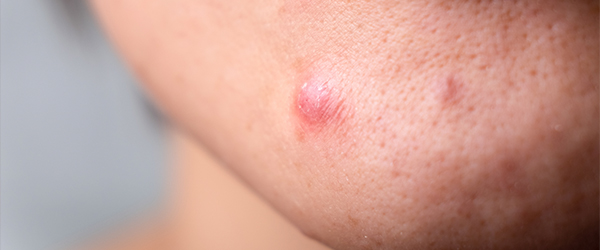 El ácido salicílico tiene propiedades antimicrobianas y seborreguladoras.