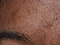 Mujer con melasma en frente