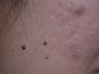 HPI Hiperpigmentación post inflamatorio