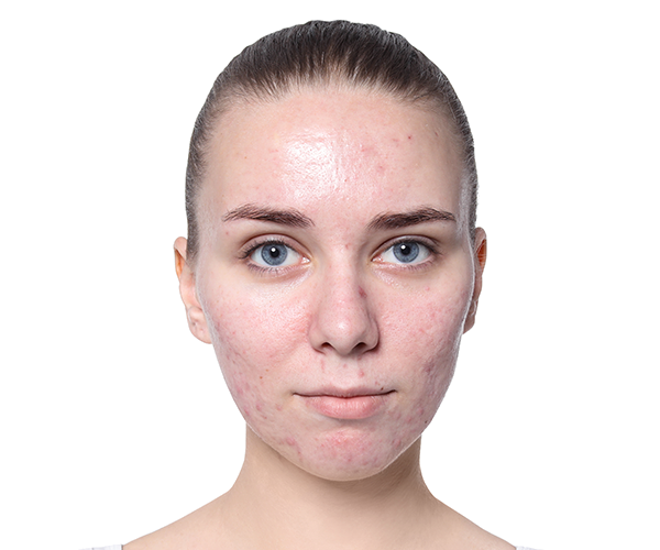Síntomas del acné facial