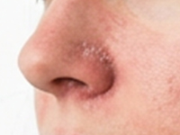 Dermatitis seborreica con descamación en las aletas de la nariz