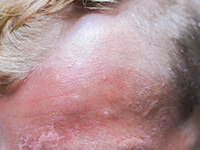 Hombre con rojez y eccema durante un brote agudo de dermatitis seborreica
