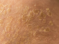 Sobrecrecimiento fúngico en la microbiota debido a dermatitis seborreica
