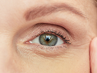 Mujer con ojeras pigmentarias