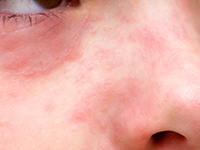 Dermatitis de contacto en piel atópica