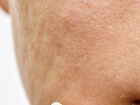 Cicatrices y hundimientos en el rostro por el acné