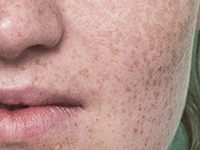 Textura irregular en el rostro